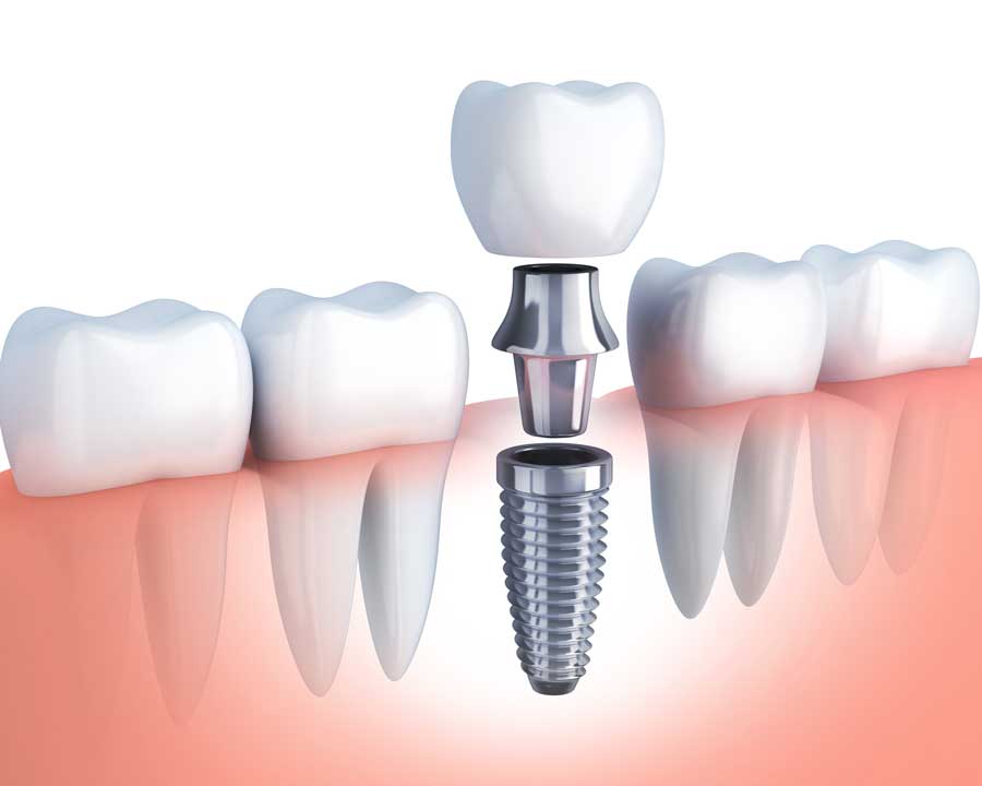 dental-implant Supreme Dental Group